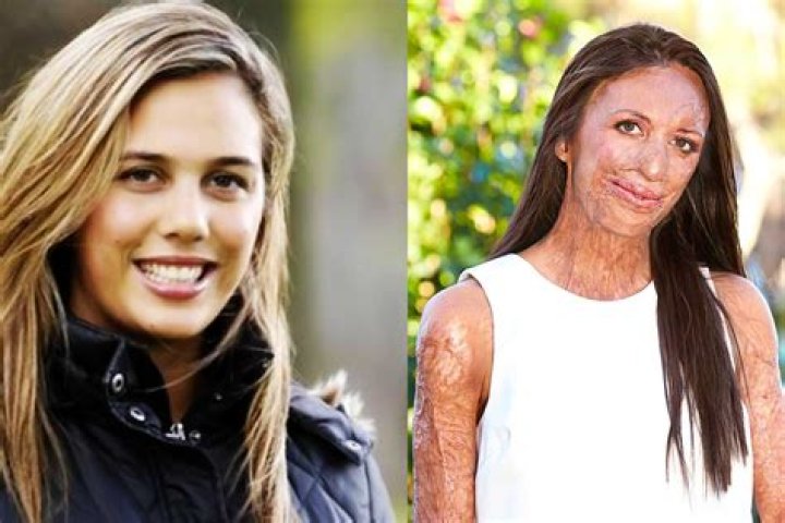 
What Happened To Turia Pitt? Accident Details And Before Photos – How Did She Get Burnt? 